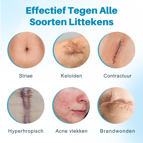 SilicFade™ | Siliconen Anti-Litteken Crème