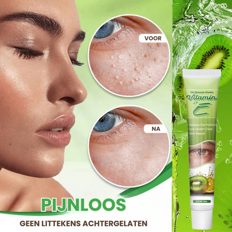 MILIAWAY™ | Milia Verwijderende Crème