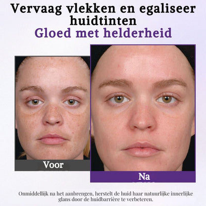 MistéqPigment™ | Anti-Hyperpigmentatiecrème