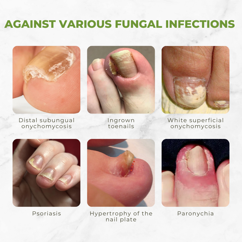 FungiVanish™ | Bijengif Nagelbehandelingsolie