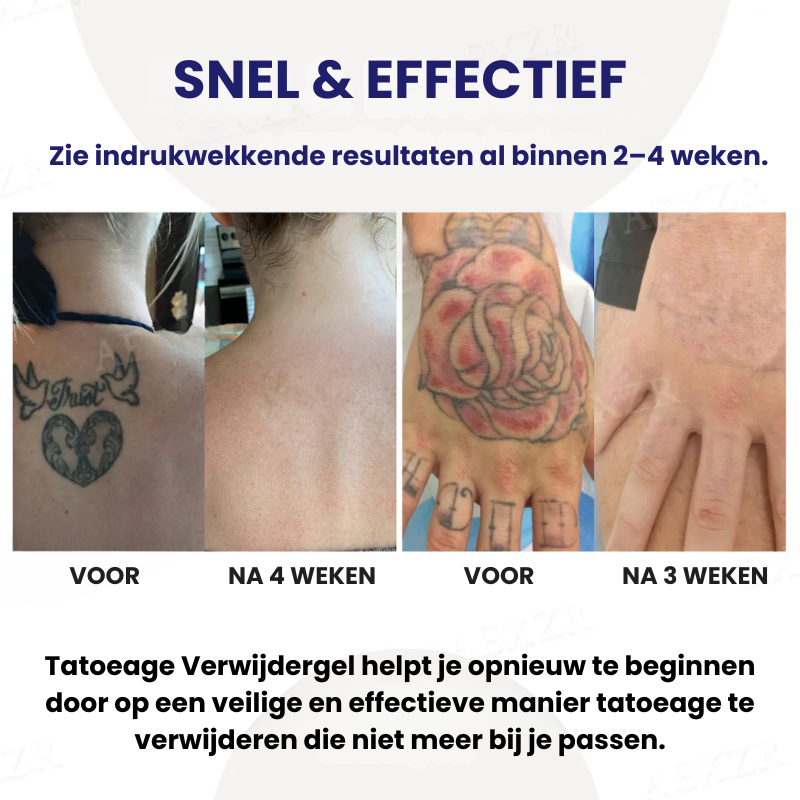 FYDETATT™ | Tatoeage Verwijdergel