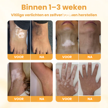 EVYNTONA™ | Huidpigmentatie Crème