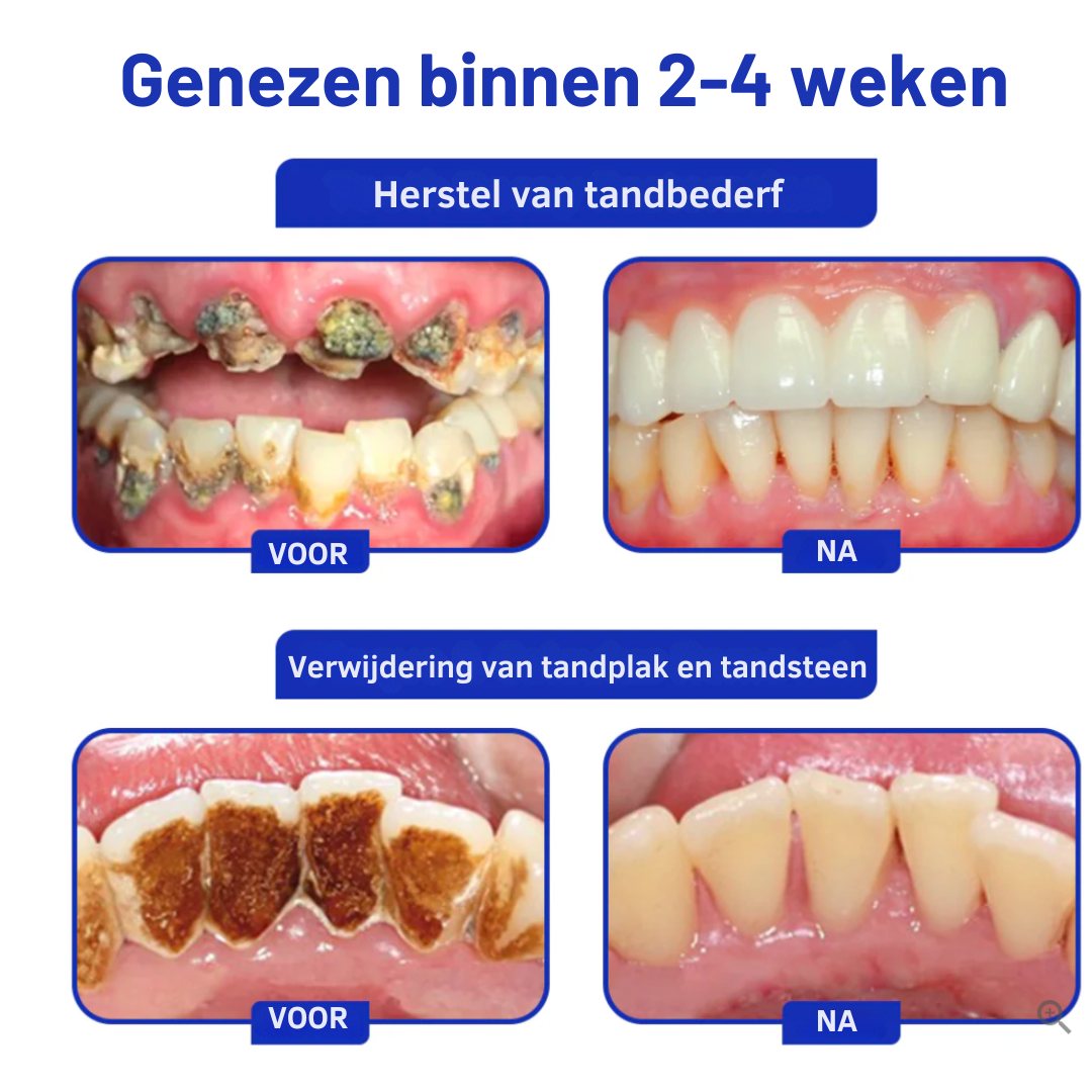 FocusSmile™ | Tandenbehandelingspoeder
