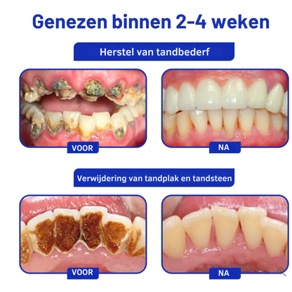 FocusSmile™ | Tandenbehandelingspoeder