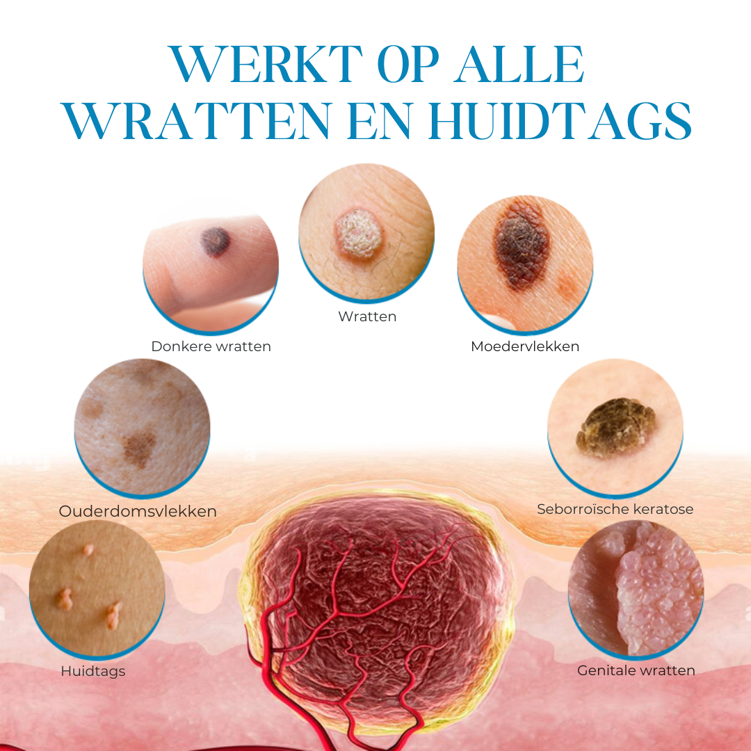 PapiClear™ | Huidtag & Wratten Crème