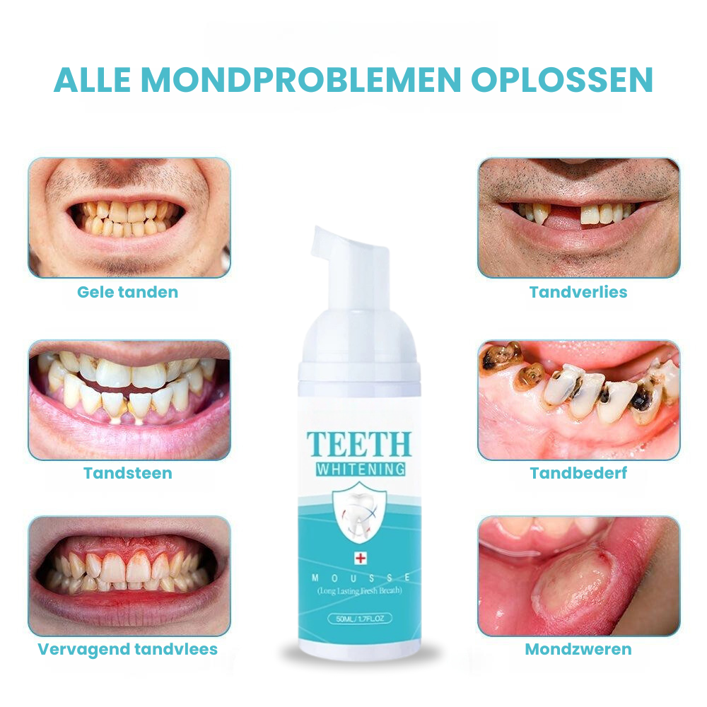 Tanden Bleken: Hoe Veilig Is Het - Tanden Bleken - Wittere Tanden - SoCleanClinic.be thumbnail