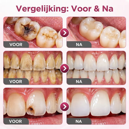 DentaFill™ | Tand Reparatie Gel