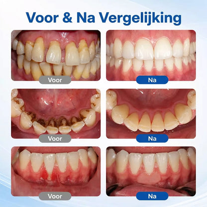 BalanceVie | Tandvlees Herstelgel - Steviger aanvoelend en rustiger tandvlees in 7 dagen