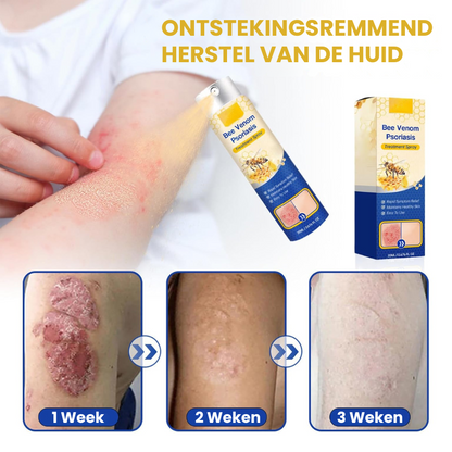PSORZEN™ | Psoriasis Verwijderings Spray