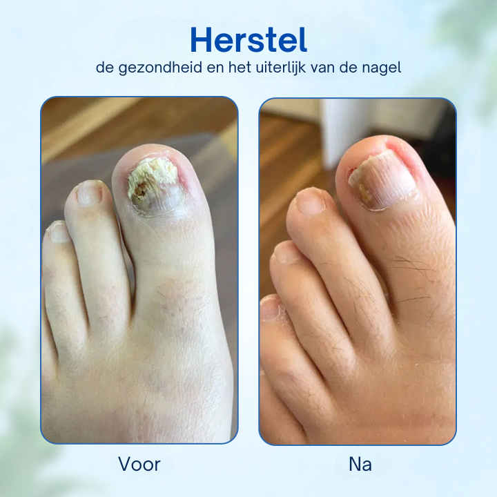 HealthyNail™ | Anti-Schimmel Nagelherstelzalf