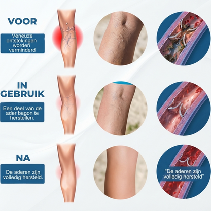 VeinRevive™ | Spataderen Herstel Crème