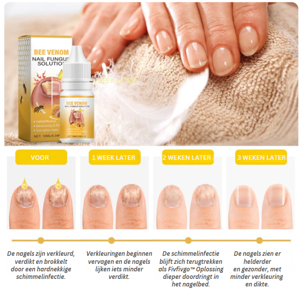 NailSoothe™ | Oplossing voor Schimmelnagels