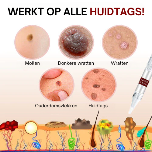 Tag Smooth™ | Huidtags en Moedervlekken Verwijderaar