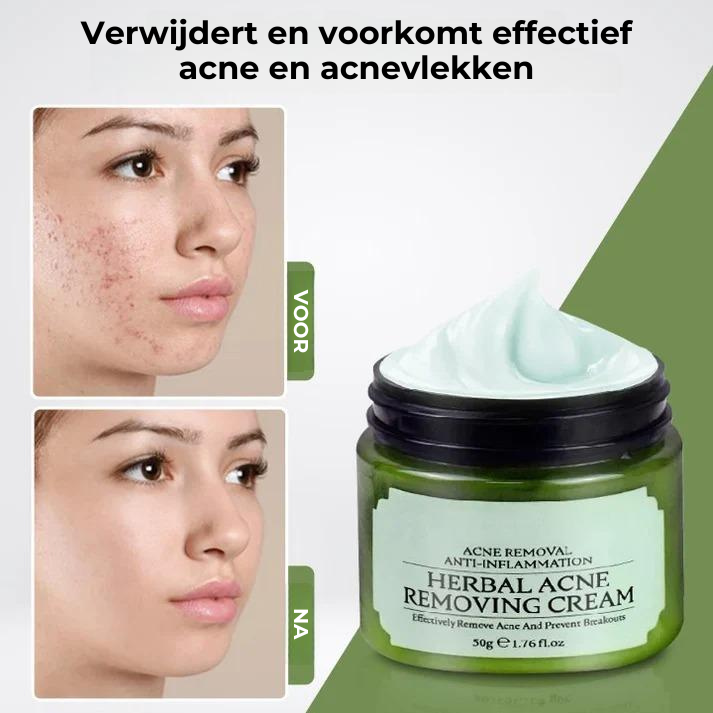 Acne Removal™ | Kruiden Acnecrème