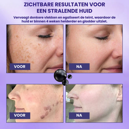 BRYTSKYN™ | Donkere Vlek Gel