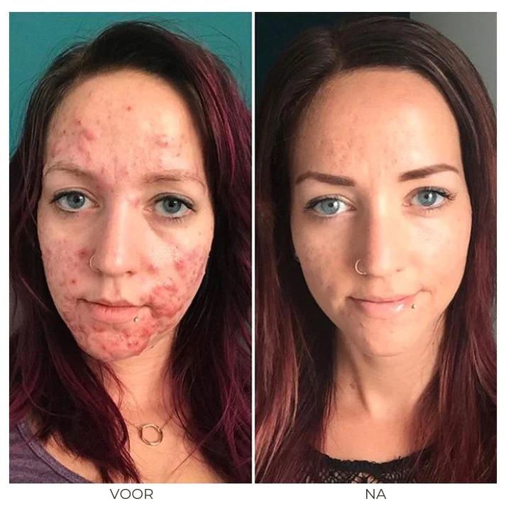 Acne Removal™ | Kruiden Acnecrème