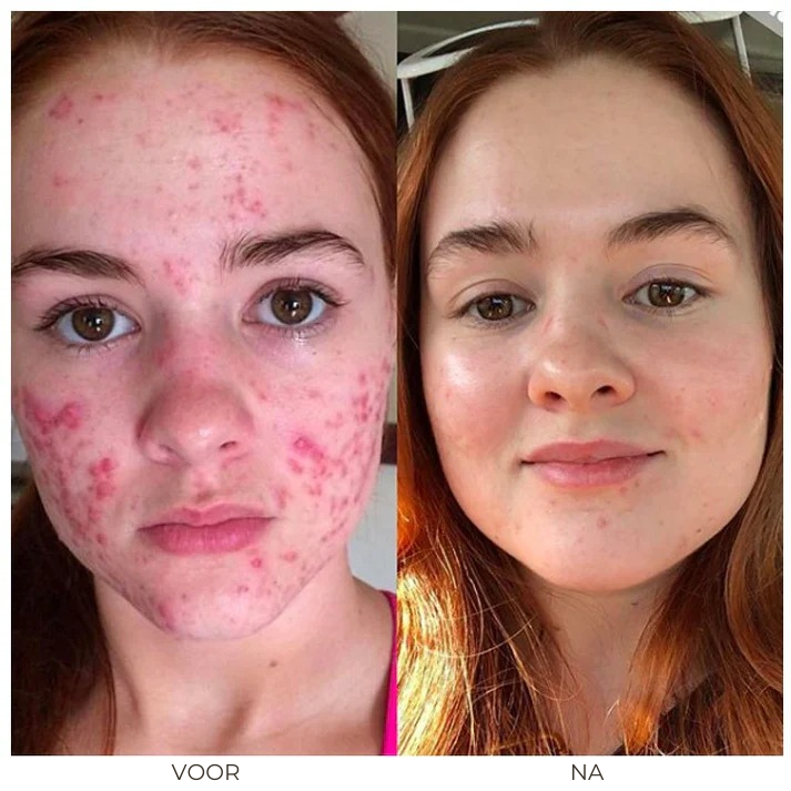 Acne Removal™ | Kruiden Acnecrème