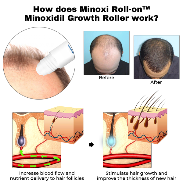 Minoxi Roll-On™ | Minoxidil Groeiroller