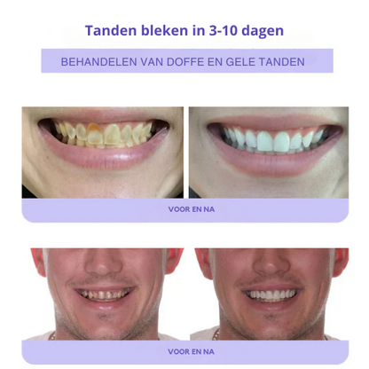 ToothBloom™ | Tanden Restauratie Mineraal Poeder