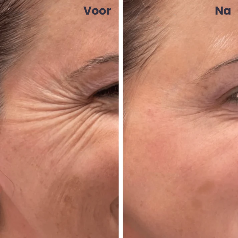 TAPELYN™ | Litteken En Rimpeltape