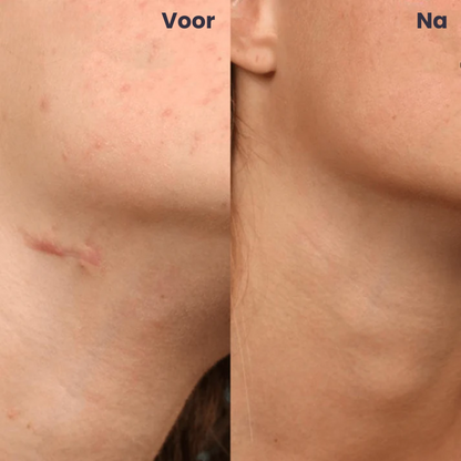 TAPELYN™ | Litteken En Rimpeltape