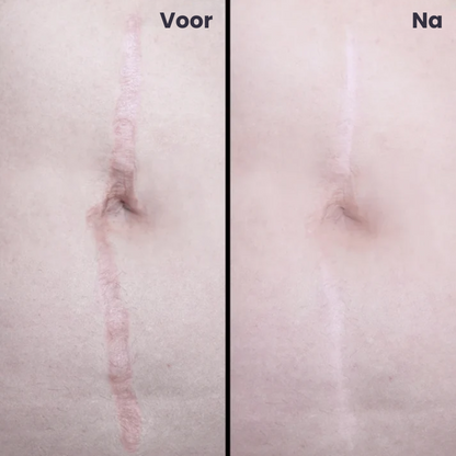 TAPELYN™ | Litteken En Rimpeltape