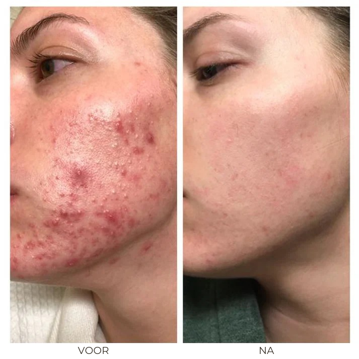 Acne Removal™ | Kruiden Acnecrème