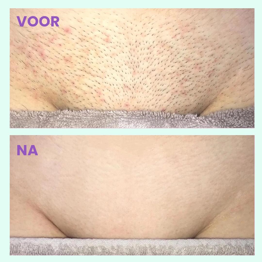 YETRA™ | Pijnloze Inductie Haarverwijderingsapparaat