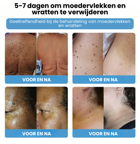 SpotGone™ | Bijengif Moedervlek- en Wrattenbehandeling Crème