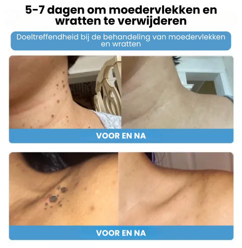 SpotGone™ | Bijengif Moedervlek- en Wrattenbehandeling Crème