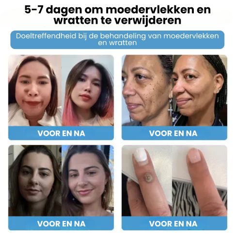 SpotGone™ | Bijengif Moedervlek- en Wrattenbehandeling Crème