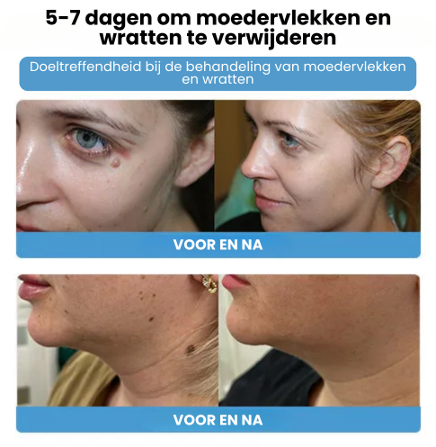 SpotGone™ | Bijengif Moedervlek- en Wrattenbehandeling Crème