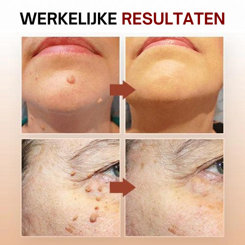 Tag Smooth™ | Huidtags en Moedervlekken Verwijderaar