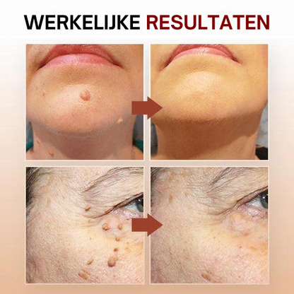 Tag Smooth™ | Huidtags en Moedervlekken Verwijderaar