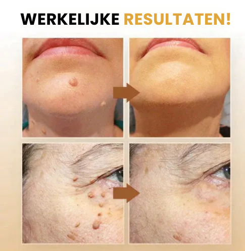 SpotGone™ | Bijengif Moedervlek- en Wrattenbehandeling Crème