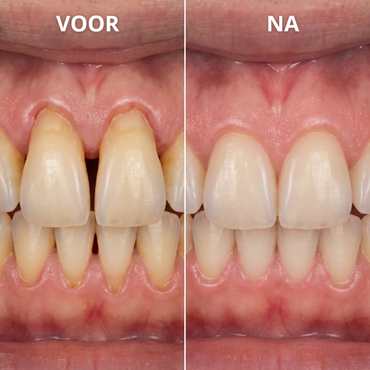 1+1 GRATIS: OralGlow™ | Tandvleesverzorgende Essentie Gel