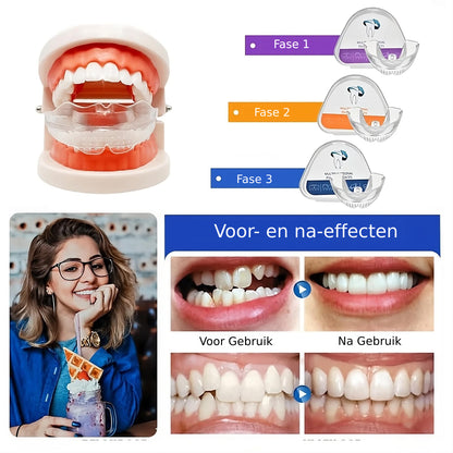 Perfecte Glimlach Align™ | Tanduitlijningsbeugel