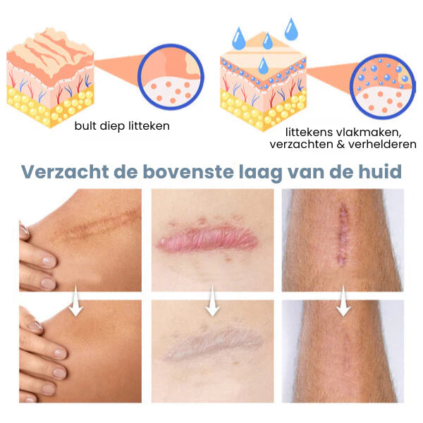 RejuvScars™ | Littekenverwijderings Gel