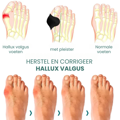 BUNIRELIX™ | Hallux Valgus Corrigerende Patch