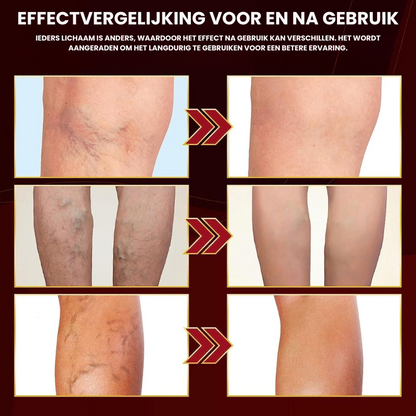 VaricoLicht™ | Spatader Spray