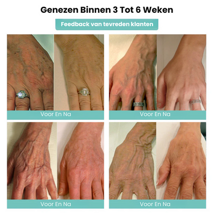 VascuMend™ | Spataderpleister